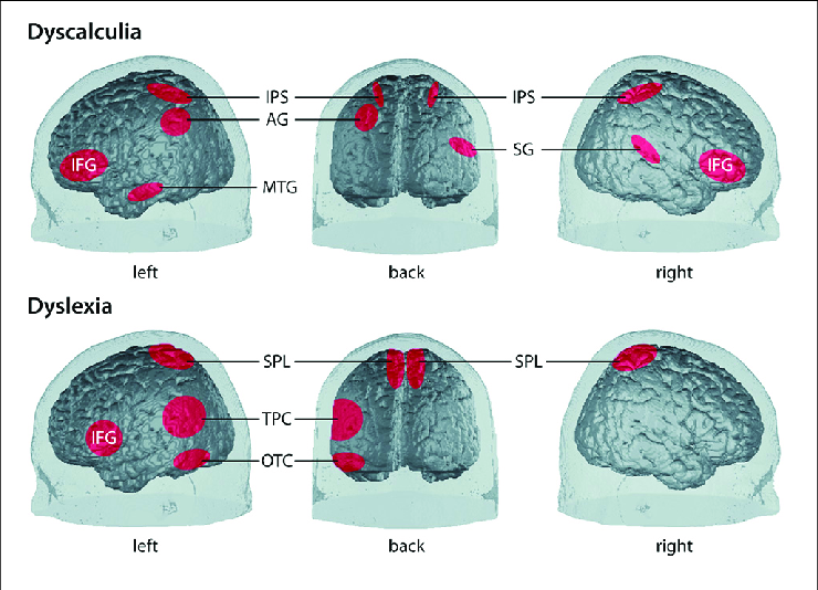 dyscalculia