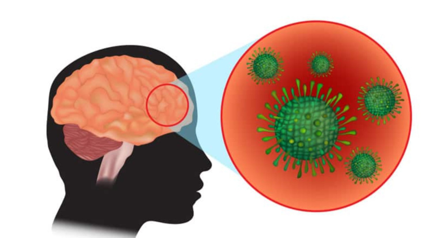 Meningitis