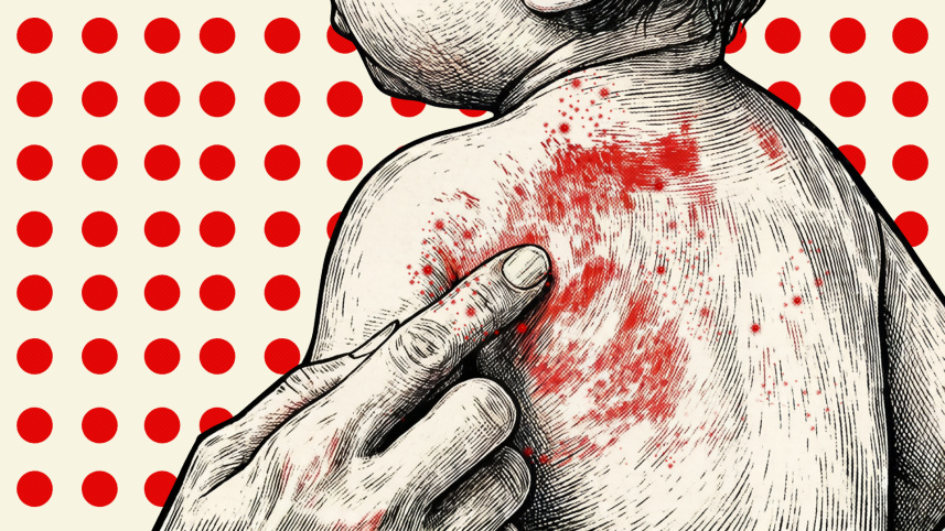 Measles
