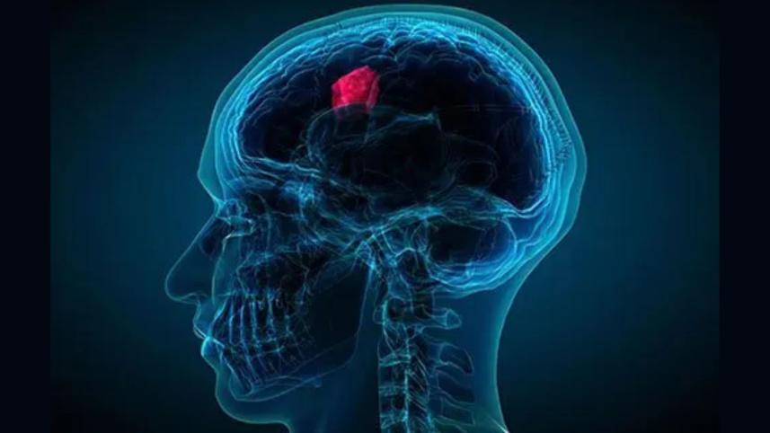 Brain Tumor