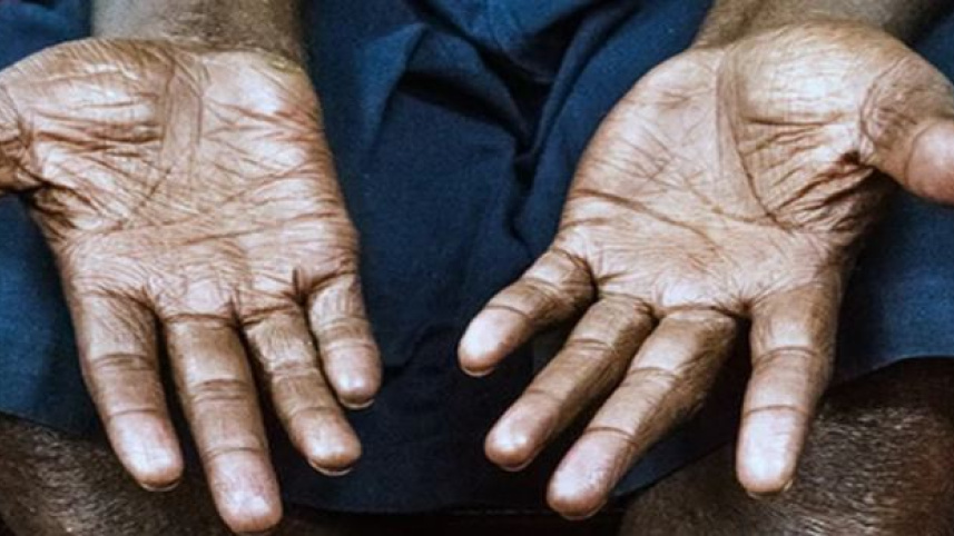 laprosy.jpg