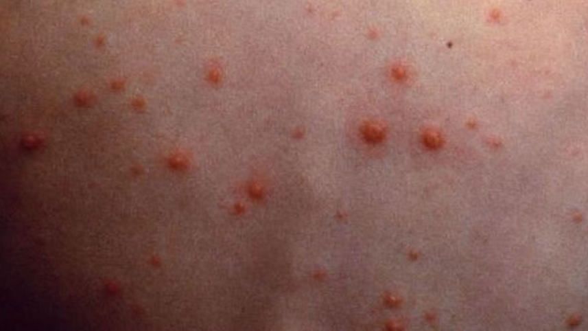 chicken-pox.jpg