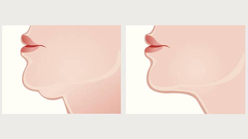 চিবুক ফুলে ব্যথা, টনসিল নাকি অন্যকিছু?