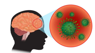 Meningitis