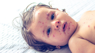 Combating-measles