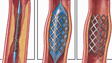 Costs of stents, dialysis may drop