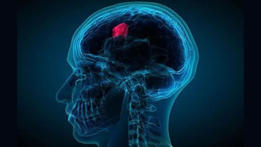 Brain Tumor