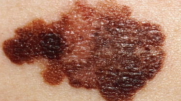 melanoma.jpg