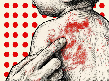 Measles